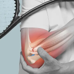 Dirsek Ağrısı (Tenisçi / Golfçü Dirseği)