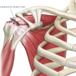 Rotator Manşet / Tendon Problemleri